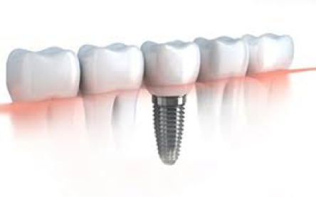 Dental Implants