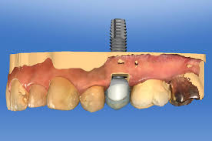 Implant Restorations